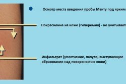 Положительная реакция Манту Положительная реакция Манту