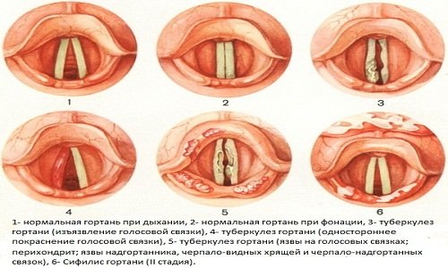Проявления туберкулеза гортани Проявления туберкулеза гортани