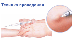 Техника проведения пробы Манту
